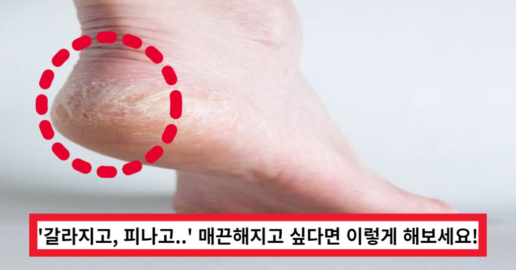 겨울철 발뒤꿈치 각질 관리하는 방법 겨울철 발뒤꿈치 각질 관리하는 방법
