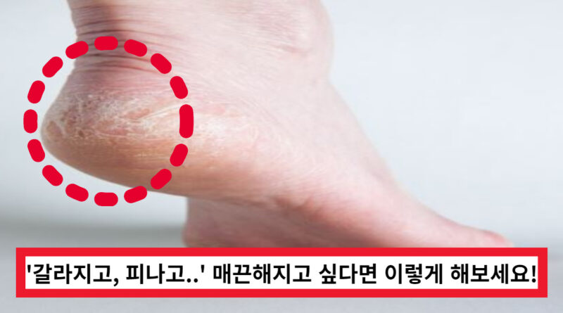 겨울철 발뒤꿈치 각질 관리하는 방법